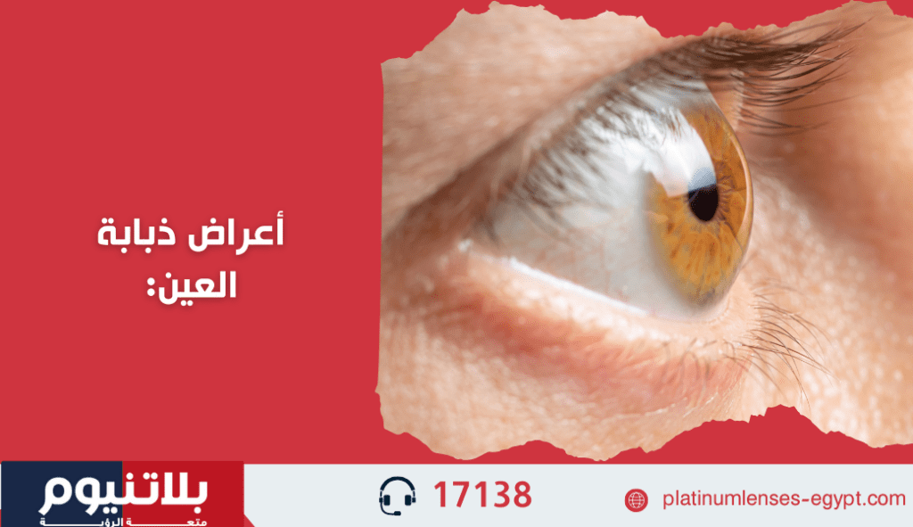 أعراض ذبابة العين: نقاط وخيوط عائمة تتحرك أمام مجال الرؤية