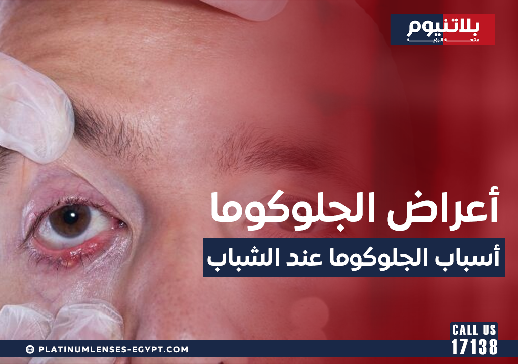 أعراض الجلوكوما وما هي أسباب الجلوكوما عند الشباب