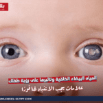 المياه البيضاء الخلقية وتأثيرها على رؤية طفلك: علامات يجب الانتباه لها فورًا