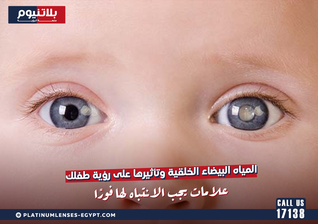 المياه البيضاء الخلقية وتأثيرها على رؤية طفلك: علامات يجب الانتباه لها فورًا